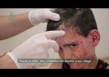 “القوباء الجلدي” ينتشر في مخيمات إدلب.. سبب الإصابة وطرق الوقاية