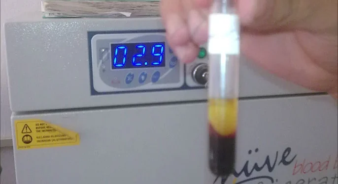 التهاب الكبد الفيروسي يجتاح سورية في مواجهة نظام صحّي مهترئ